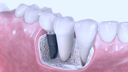 Dental Implant Cost in NYC - Implant Dentist - 212 Smiling